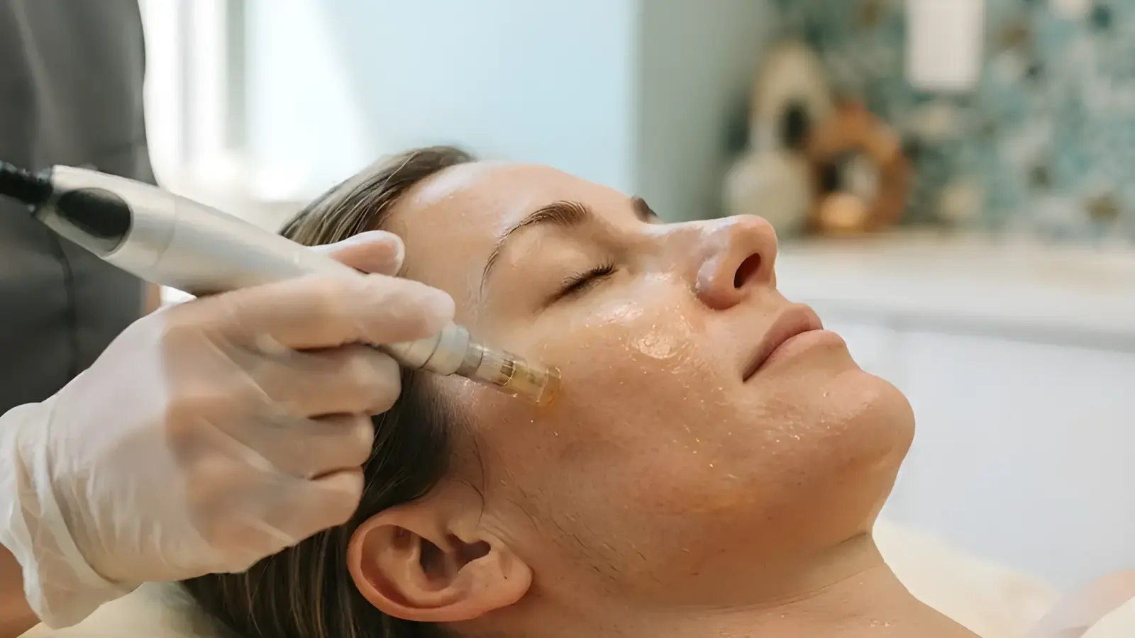Microneedling with PRP being performed in the Arlington Heights treatment room